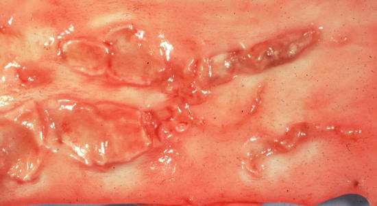 chronische Endarteriitis (verkalkte Plaques)
