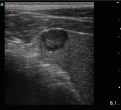 Abb.1: Sonographie Milztumor