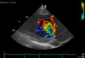 Abb.3: Farbdoppler zur Blutflussdarstellung