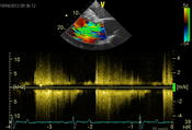 Abb.4: Spektraldoppler Messung der Blutflüsse