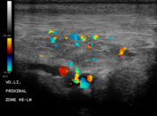 Darstellung der Durchblutung der Sehne im Längsschnitt mit dem Gefäßdoppler
