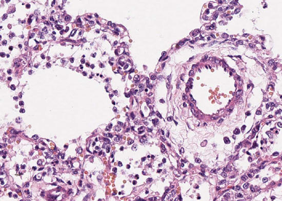 Lunge, Calicivirusinfektion: Interstitielle Pneumonie, &Ouml;dem