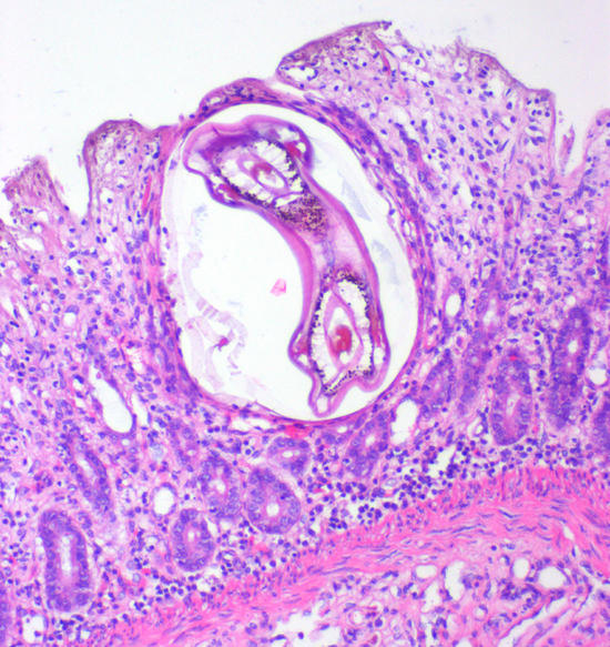 Larve IV in der Mukosa des Dickdarmes