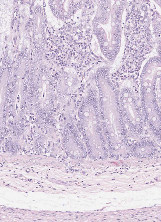 Ausschnitt Darmwand: Kryptepithelhyperplasie, geringgradige Enteritis