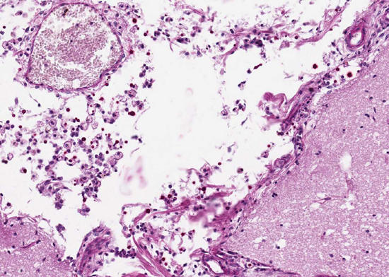 Leptomeninx: geringgradige, lymphoplasmazelluläre und histiozytäre Leptomeningitis