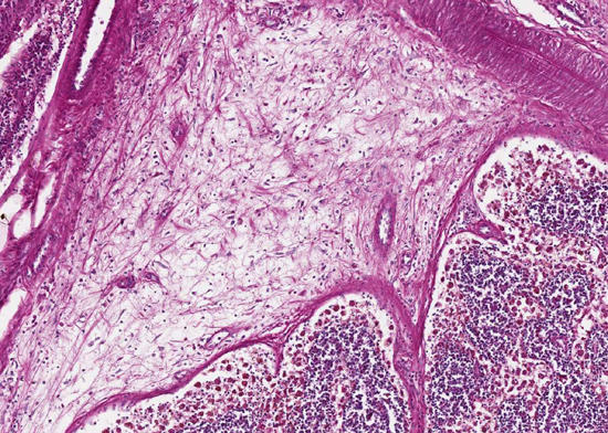 Lymphknoten, weitgehende Aulösung dre Lymphknotenstruktur