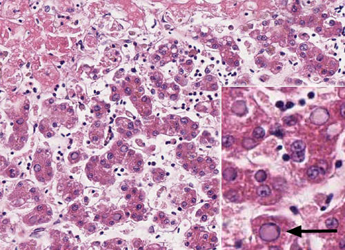 Histologiches Bild der Leber bei Pacheco Krankheit