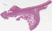 Histologie: Plattenepithelkarzinom