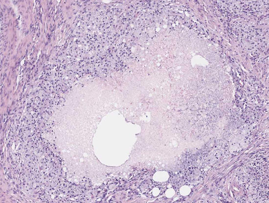 Dünndarm: Lipogranulome Übersicht (Mesenterium)