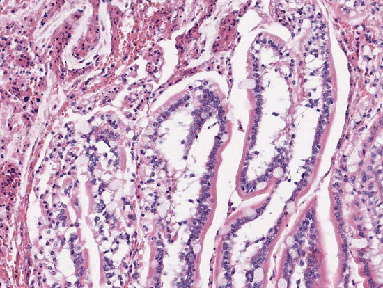Lymphgefäßerweiterung in den Dünndarmzotten (Lacteals)