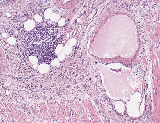 Dünndarm: Lymphgefäßassoziation der Lipogranulome, Lymphgefäßstau