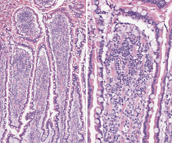 ünndarmzottenerweiterung und Lymphgefäßstau