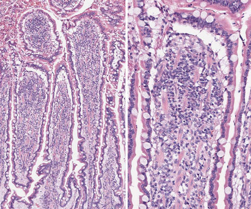 Pathohistologisches Bild einer Darmzotte bei PLE