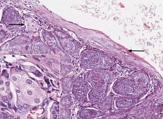 Prim&auml;rfollikel ausgekleidet mit mehrschichtigem Plattenepithel