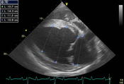 Fig.2: 2D cardiac ultrasound with measurements