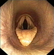 Fig.11: Endoscopy of the larynx