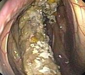 Fig.10: Air sac mycosis