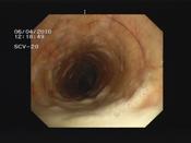 Fig.4: Accumulation of secretions in the trachea