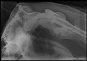 Fig.1: Myelography cervical spine