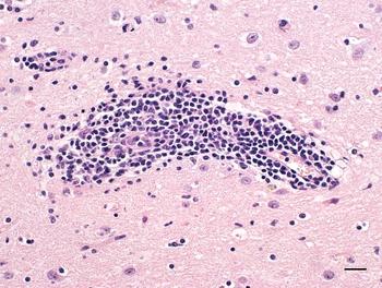 Gehirnentzündung bei einer Katze mit einer Rustrelavirusinfektion. Um die Blutgefäße des Gehirns finden sich zahlreiche Immunzellen, sogenannte Lymphoyzten.